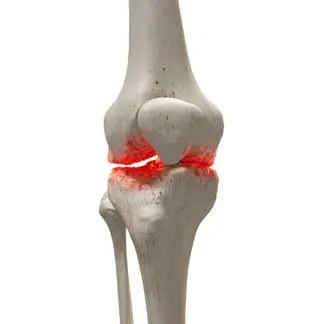 Image of Cartilage and Arthritis