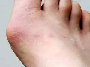 A picture of a foot with bunions